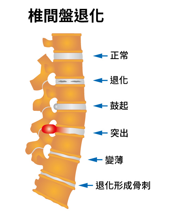 頸肩椎間盤退變包括正常椎間盤,退行性椎間盤,膨出椎間盤,椎間盤突出,變薄椎間盤和具有骨贅形成的椎間盤退變。