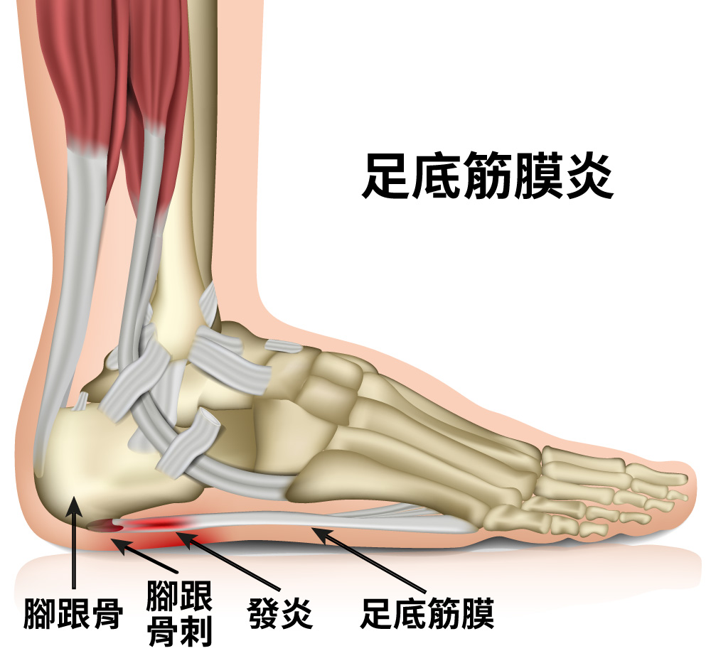 足底筋膜炎，發炎，腳跟骨，腳跟骨刺